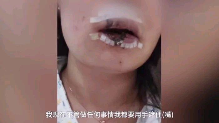 女子给朋友狗喂食,嘴唇被咬掉一半,医生:咬掉那一半找不到,已经没有办法复