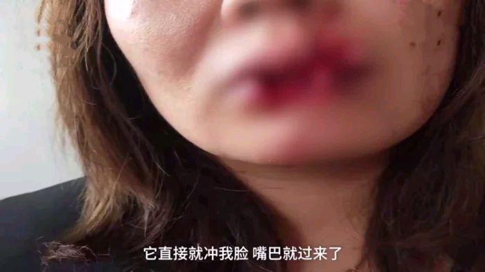 女子给朋友狗喂食,嘴唇被咬掉一半,医生:咬掉那一半找不到,已经没有办法复