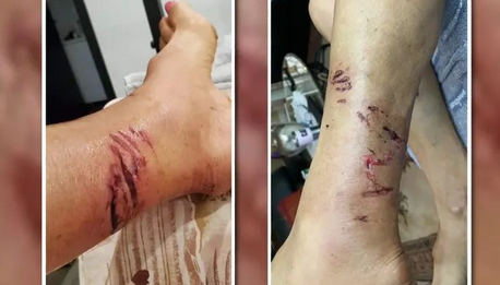 惨!加拿大女子遛狗回家遭一群浣熊撕咬!腿上留下血洞抓痕!